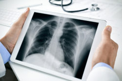 asbestos lung cancer chest X-ray