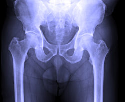 DePuy Zimmer hip implant hip replacement hip X-ray