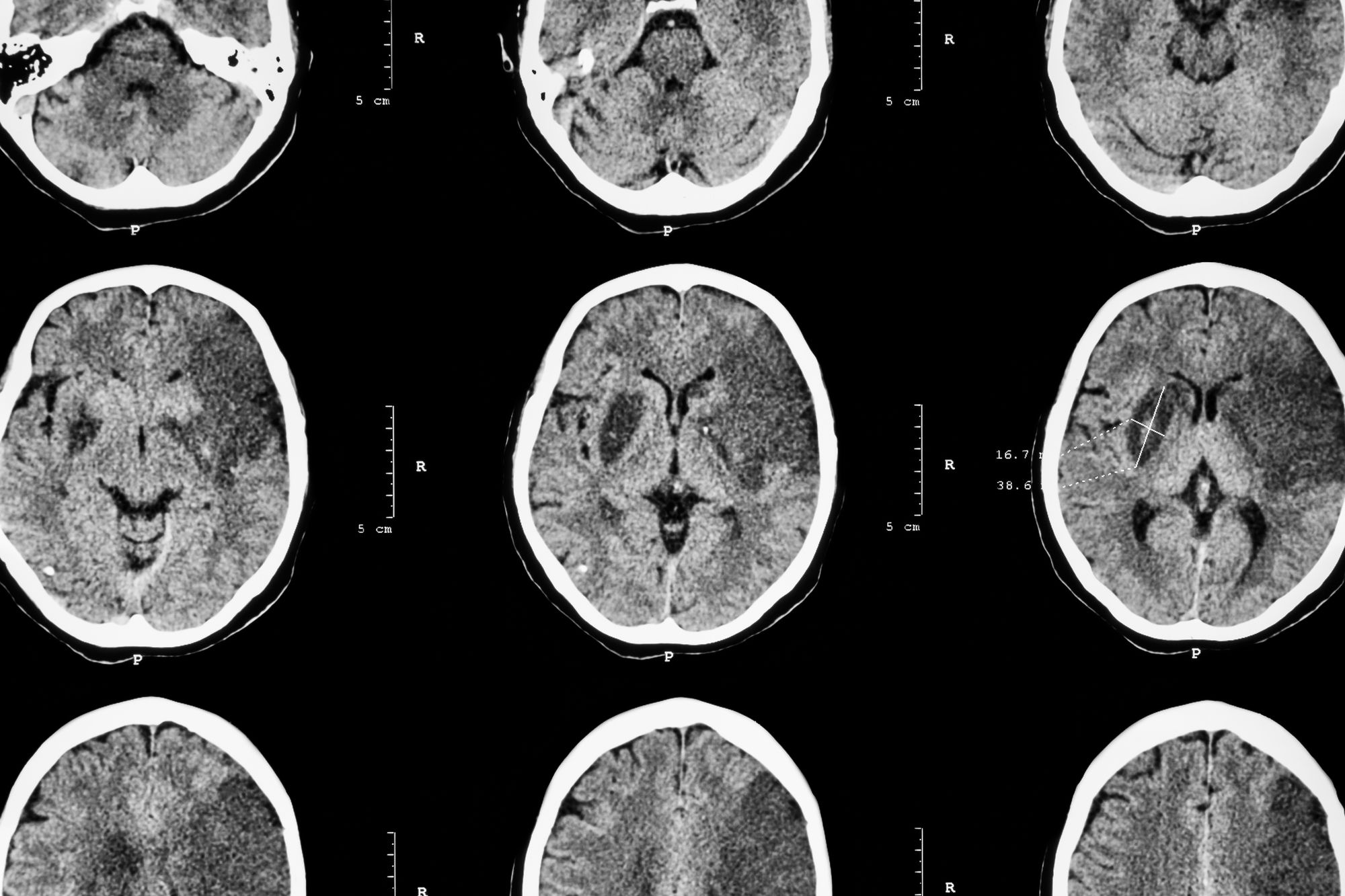 Couple Files Blood Thinner Xarelto Lawsuit over Intracranial Hemorrhage