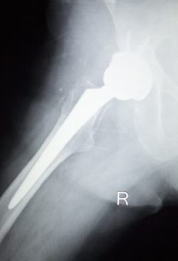 metal hip replacement