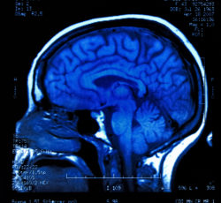 Dilantin cerebellar atrophy blue brain MRI