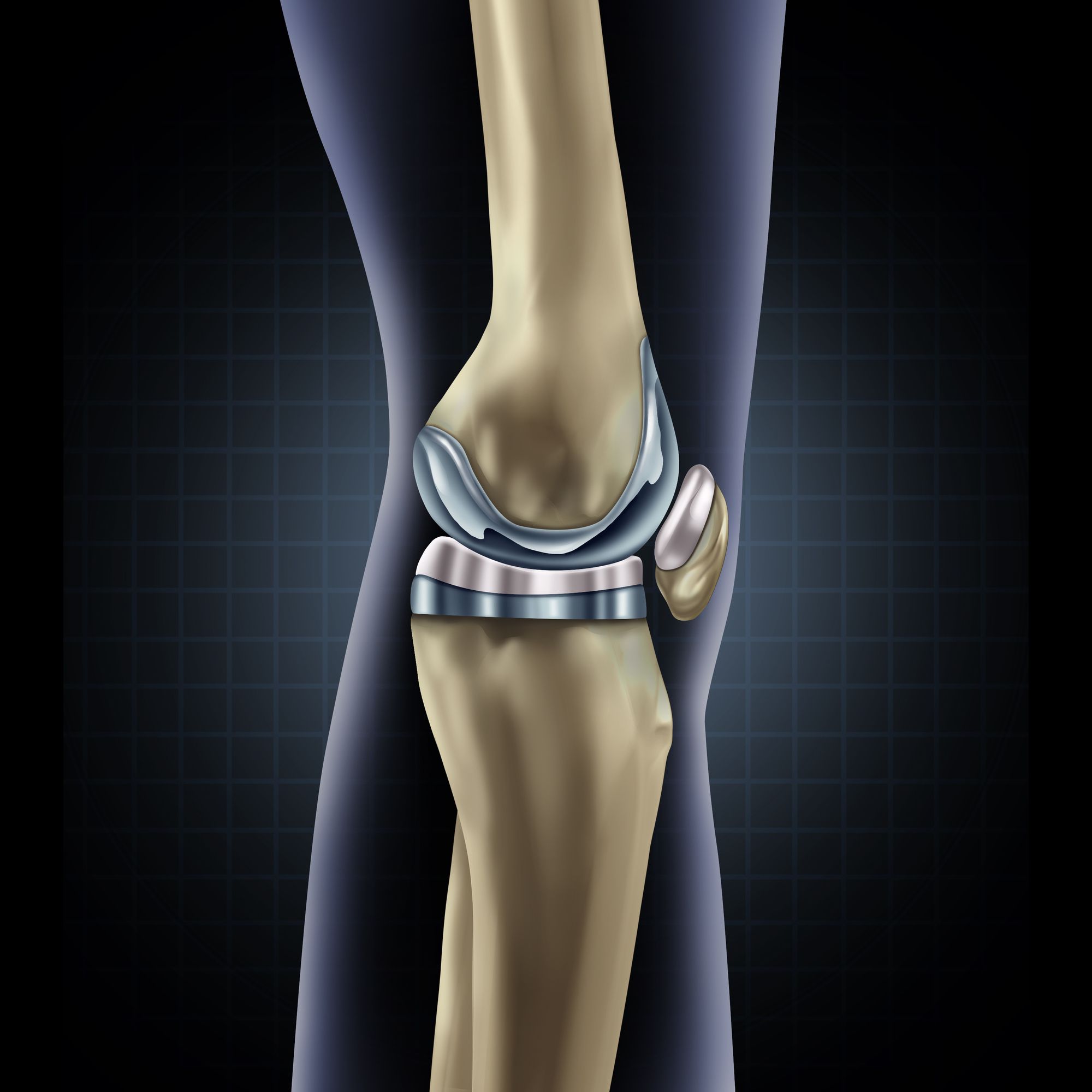 Tka Rim Plate Arthrex iBalance TKA Tibial Plate Recall Withdraws Devices from Market