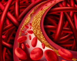 Artery problem with clogged arteries and atherosclerosis disease medical concept with a three dimensional human cardiovascular system with blood cells that blocked by plaque buildup of cholesterol as a symbol of vascular diseases.