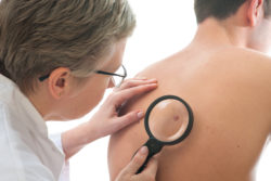 Viagra Cialis skin cancer melanoma