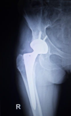 DePuy Zimmer hip replacement hip implant