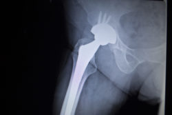 X-ray scan image of hip joints with orthopedic hip joint replacement implant head and screws in human skeleton in blue gray tones. Scanned in orthopedics traumatology surgery hospital clinic.