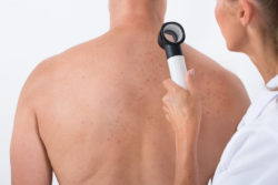 Viagra melanoma skin cancer doctor examining man