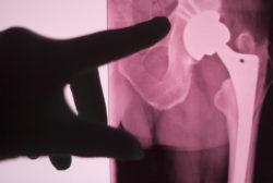 Hand pointing to hip implant X-ray, illustrating ASR hip replacement settlement