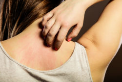 Rash From Lamictal May Be First Sign of a Dangerous Immune Reaction