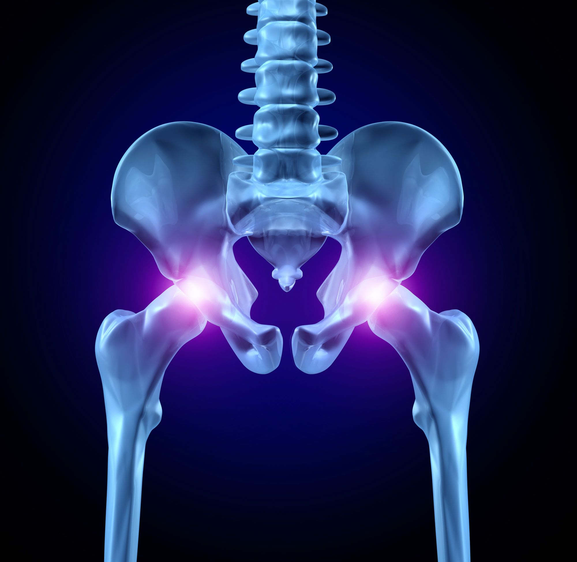 Stryker Hip Replacement Causes Serious Side Effects, Lawsuit Claims
