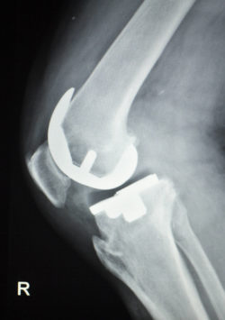 Zimmer knee replacement devices are used in knee implant surgery