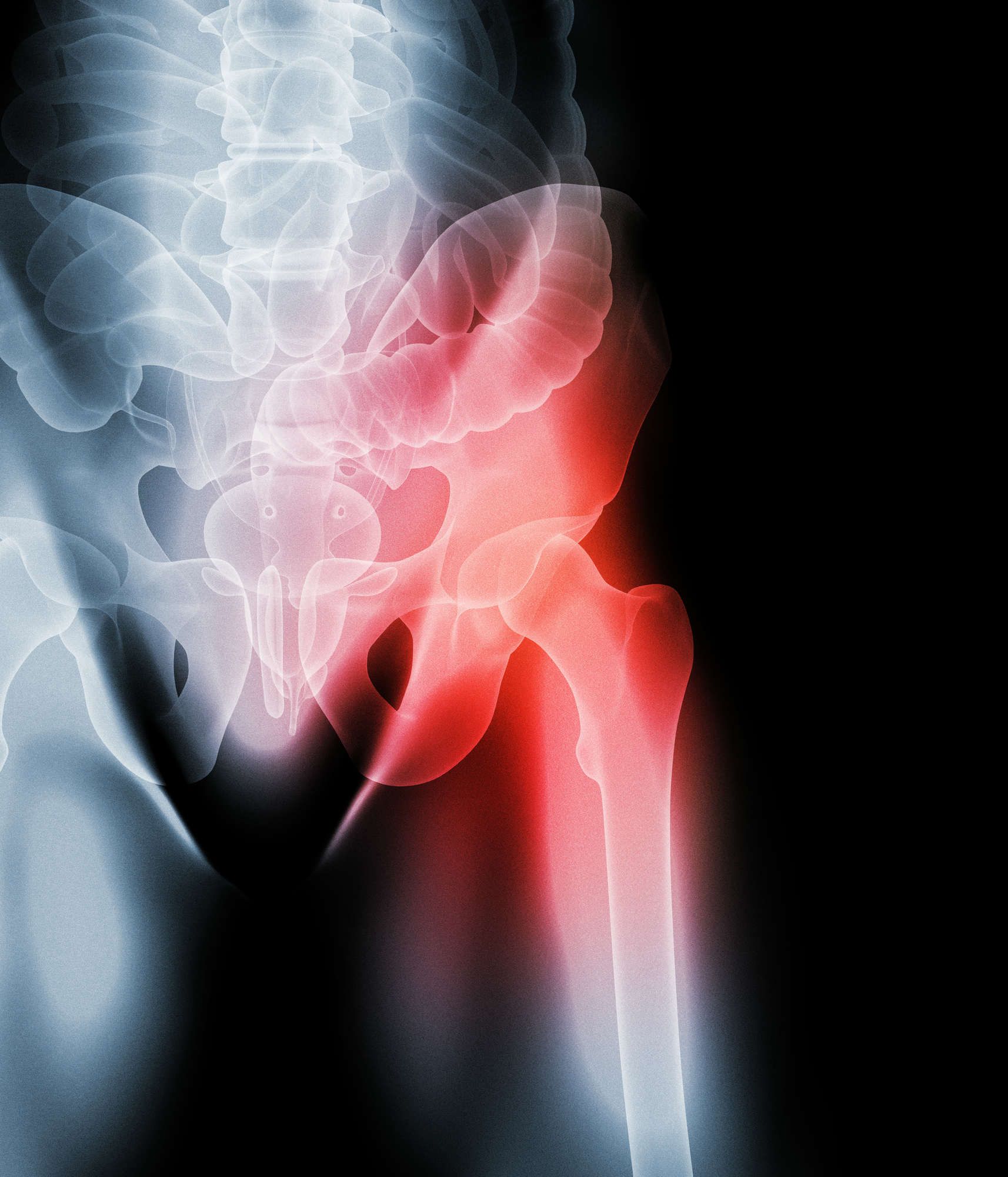 Couple Files DePuy ASR Hip Lawsuit Joining Growing MDL