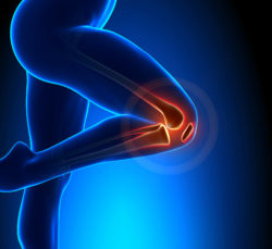 Have You Suffered Injuries After Arthrex Total Knee Replacement?