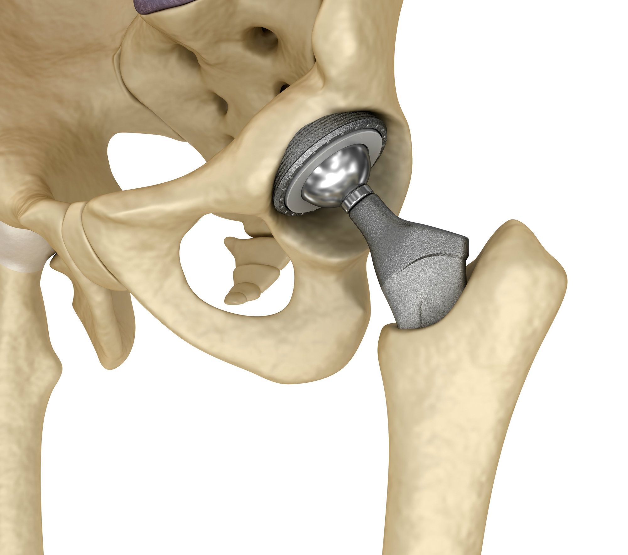 Couple Alleges Problems with the DePuy ASR Hip Implant System - Top ...