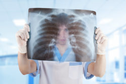 xray of lungs with asbestos cancer