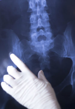 Man Files Lawsuit Alleging Severe Stryker LFIT Hip Replacement Complications