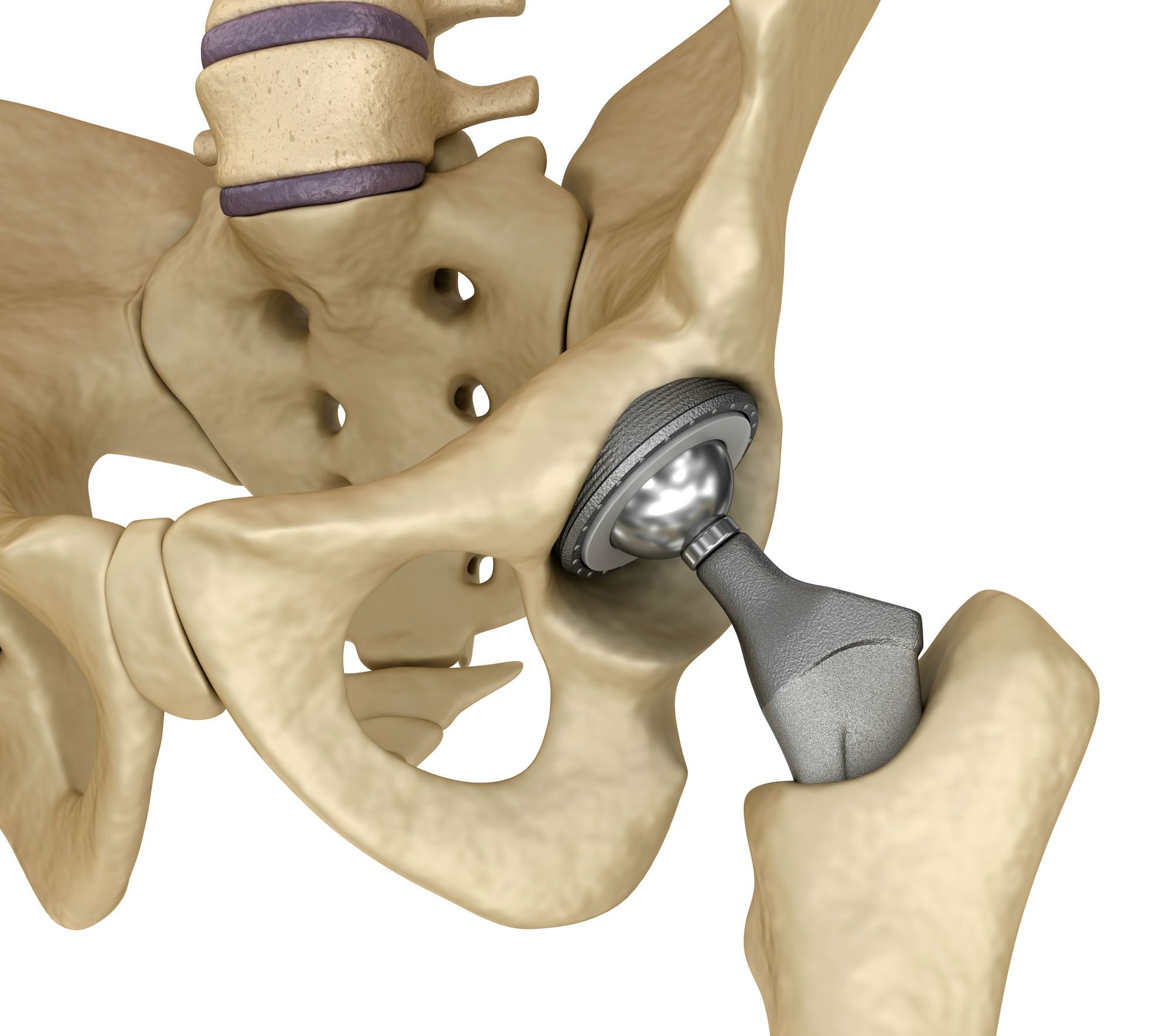 In Lawsuit, Michigan Patient Says Biomet Magnum Hip Implant Is Defective