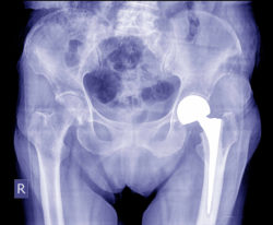 Stryker LFIT V40 Failure Common With Howmedica Hip Replacement, Lawsuit Claims
