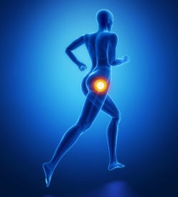 Woman Files Lawsuit After Hip Revision Surgery Necessitated by Stryker LFIT V40 Recall
