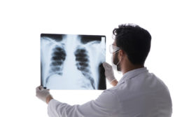 Asbestos Exposure may be Among Risk Factors For Lung Cancer