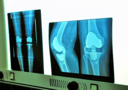 High Viscosity Bone Cement Linked to Premature Knee Implant Failure