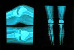 Knee Replacement Cement Failure May Lead to Revision Surgery