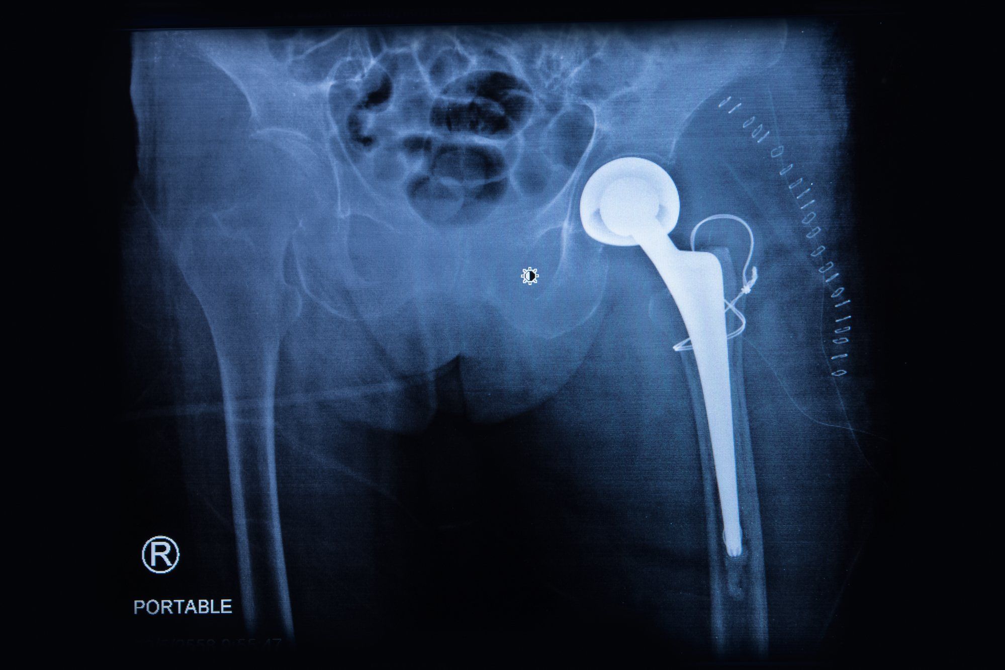 Couple Files Stryker Hip Replacement Lawsuit Top Class Actions