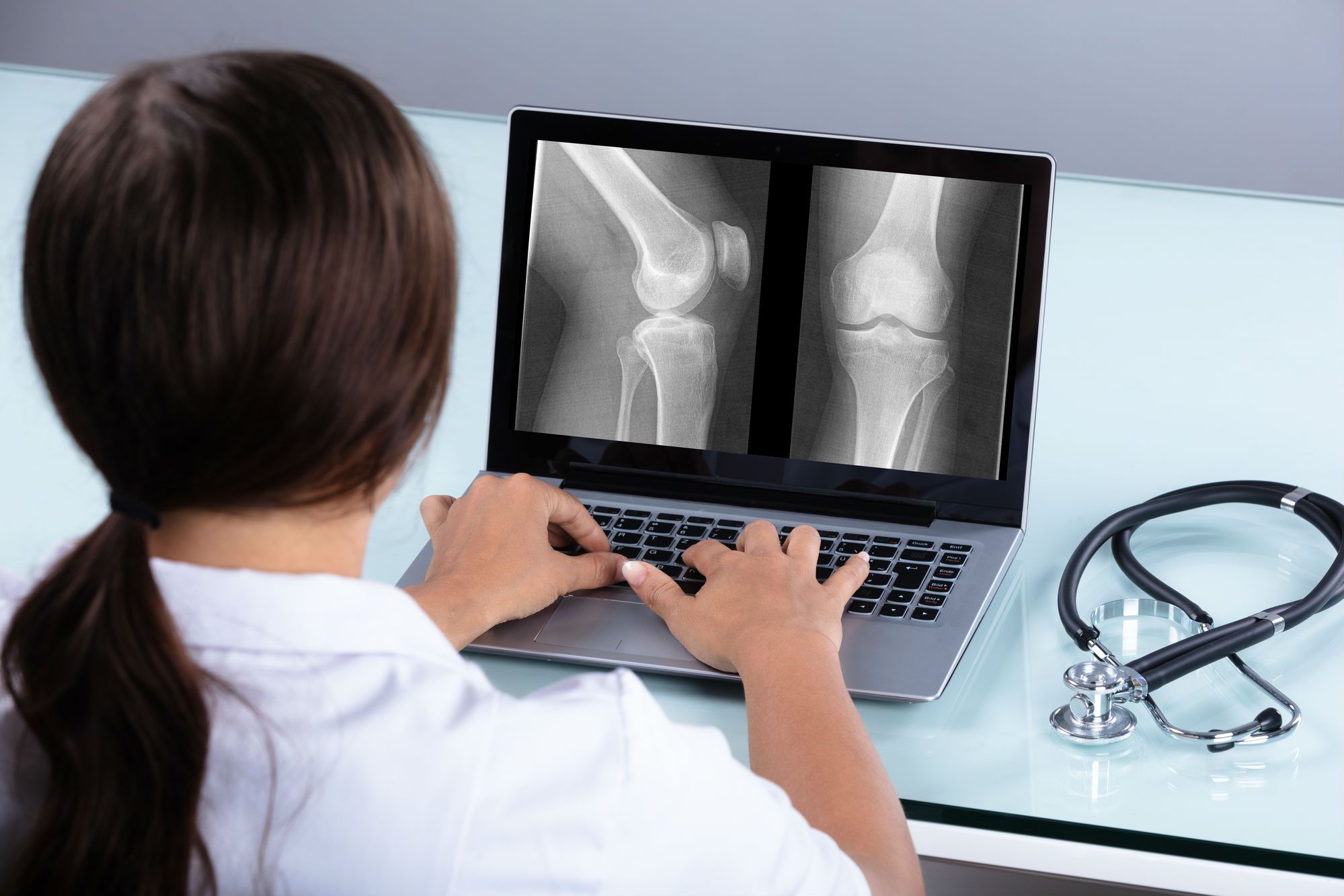 Knee Bone Cement Linked to Aseptic Tibial Loosening