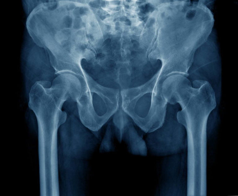 Zimmer Hip Replacement System Blamed for Serious Injuries