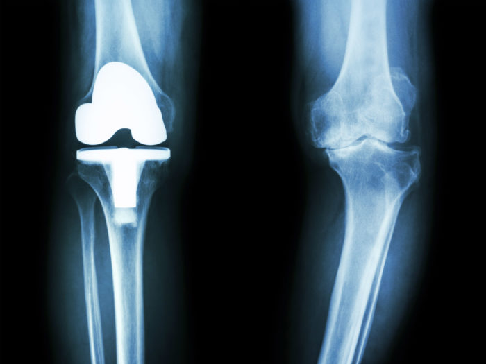 Bone Cement Failure May Lead to Need for Knee Revision Surgery