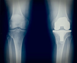 An X-ray shows two knees, one of which has a knee implant.