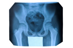 X-ray of hip