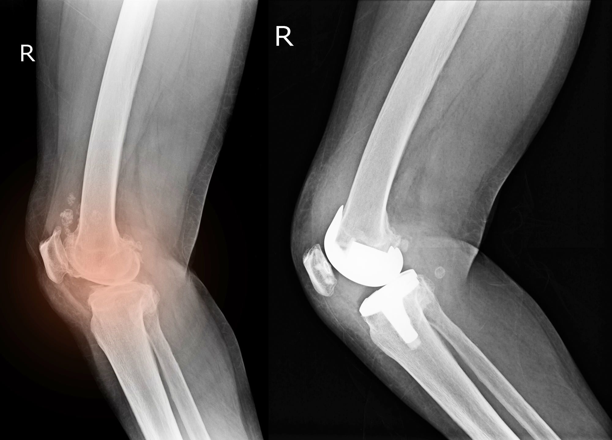 Zimmer Persona Tibial Plate Loosening Might Result in Knee Revision