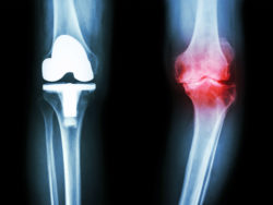 Knee X-ray shows damage and replacement.