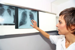 A nurse examines a chest X-ray.