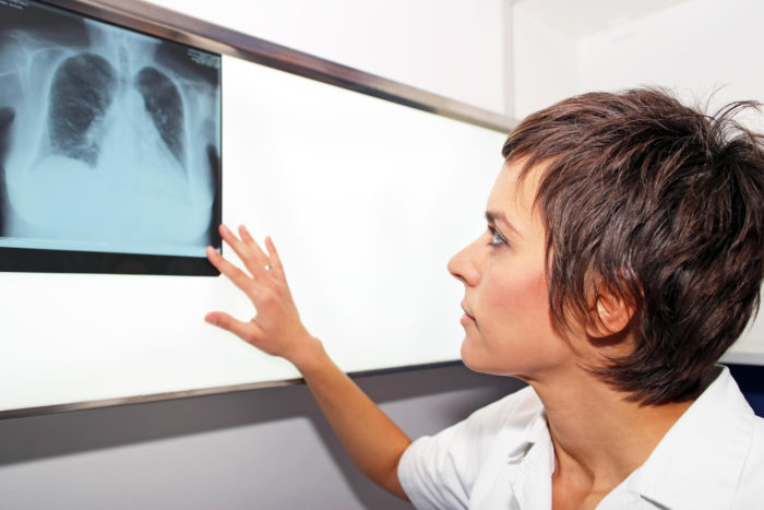 Doctor looking at x-ray of pulmonary embolism