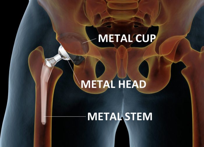 Man Files Zimmer Metal on Metal Hip Replacement Lawsuit Top Class Actions