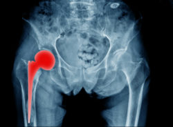 MRI image of hip implant