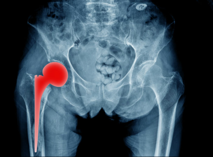Were You Affected by the 2012 Stryker Hip Implant Recall?