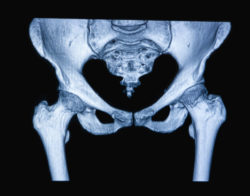 MRi of hip