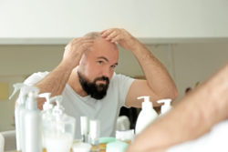 Adult man with hair loss