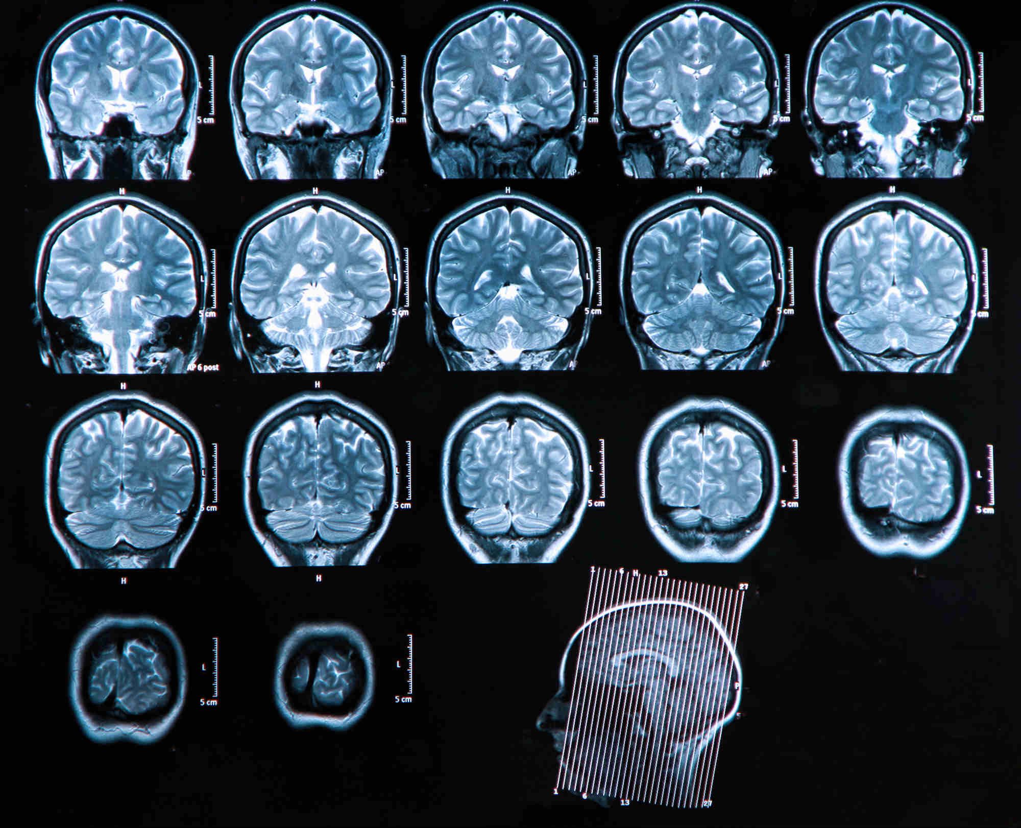 What Can Cause Cerebellar Atrophy?