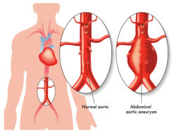 Diagram of aortic aneurism