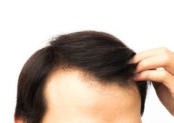 man considering Capillus hair loss treatment