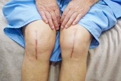 Woman requiring revision total knee replacement shows her scars