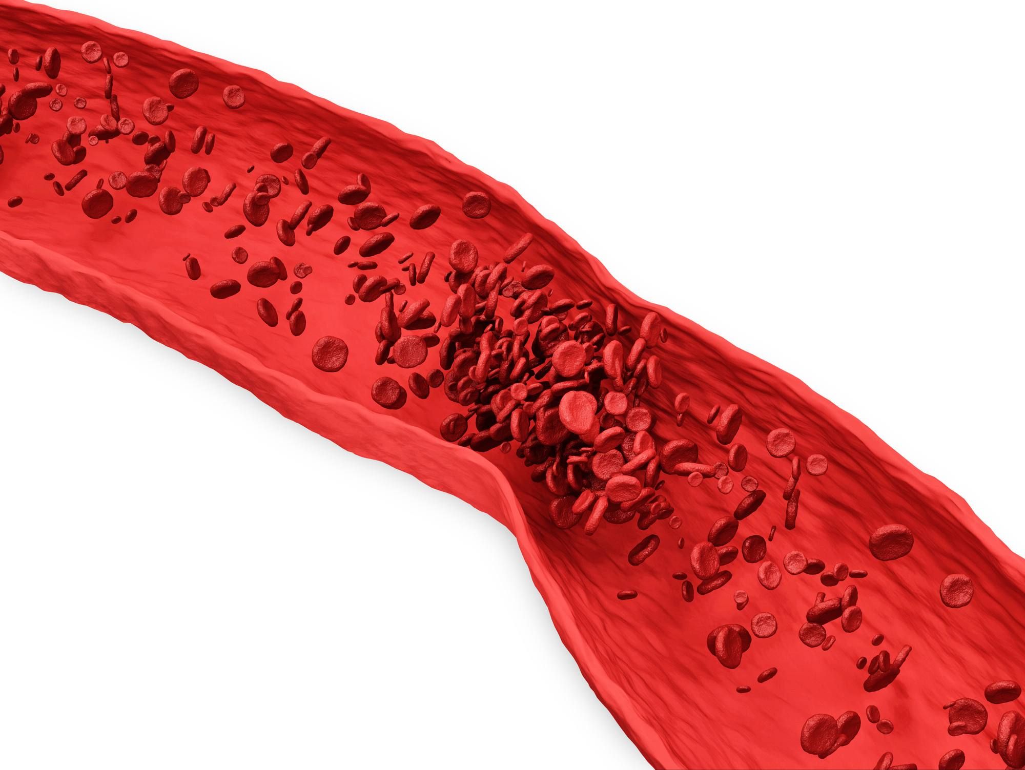Blood clot in artery