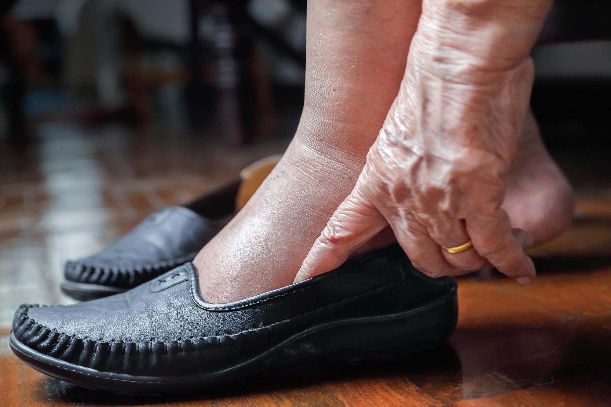 Elderly woman with swollen feet