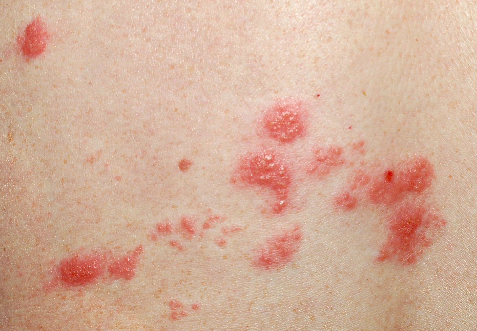 Can You Get Shingles After Being Vaccinated? Top Class Actions