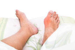 Taking Uloric for gout may have dangerous cardiovascular side effects.