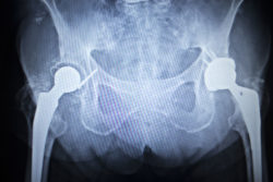 Xray shows two hip replacements in patient